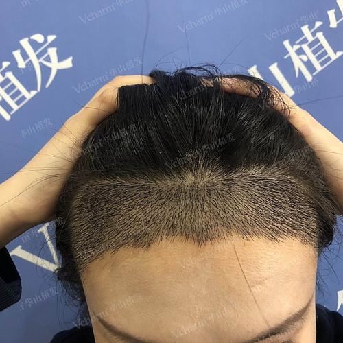 广州新生植发效果怎么样呢？医院详情介绍，案例分享！