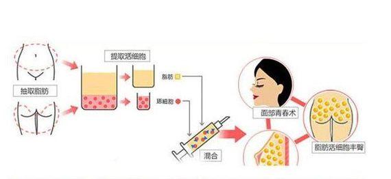 武汉哪个医生做脂肪填充好？想要完美的效果可以找这几位医生！