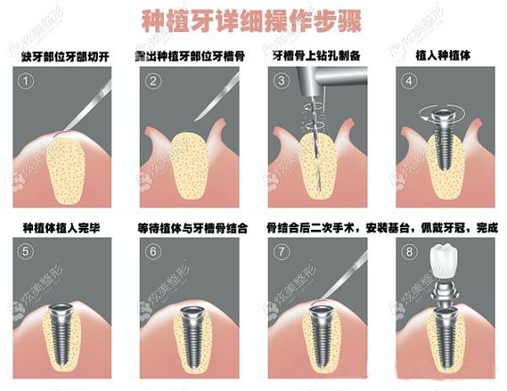 佛山登特口腔全口种植牙价格表？全口种植牙齿价格8万元起