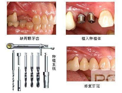 唐都医院种植牙技术怎么样？众多成功案例，专家团队经验丰富，患者口碑如何？