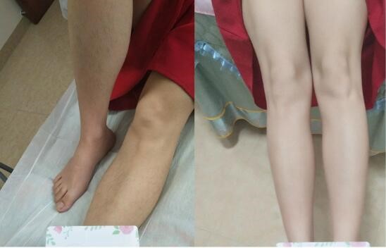 贵阳植发医院哪家好？推荐春草植发，技术专业，效果显著(图2)